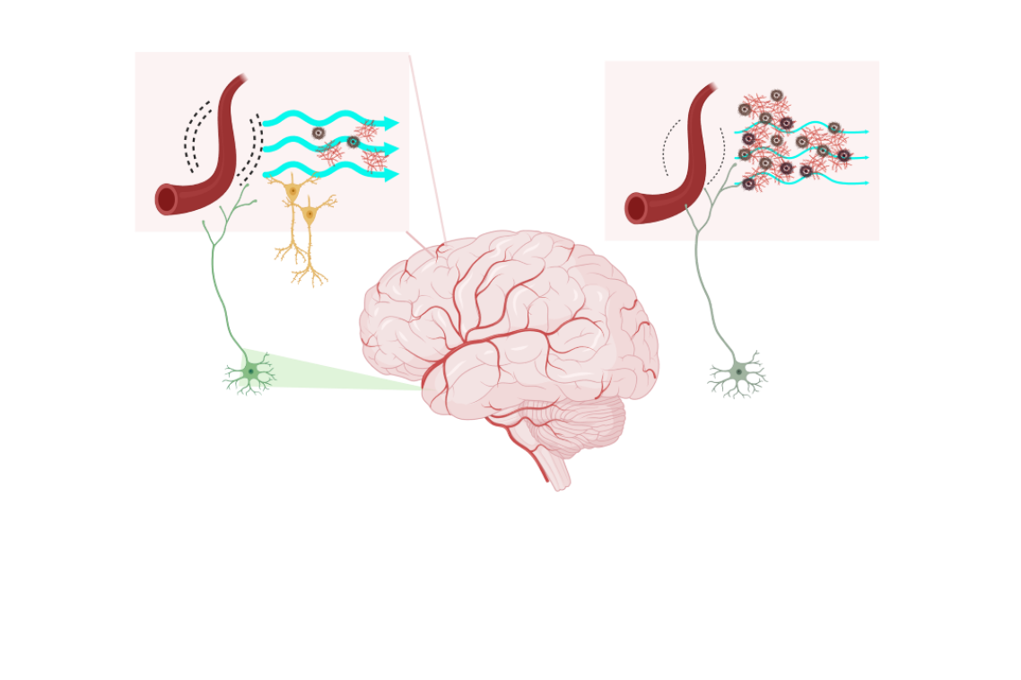 Graphic of how waste can build up in the brain.