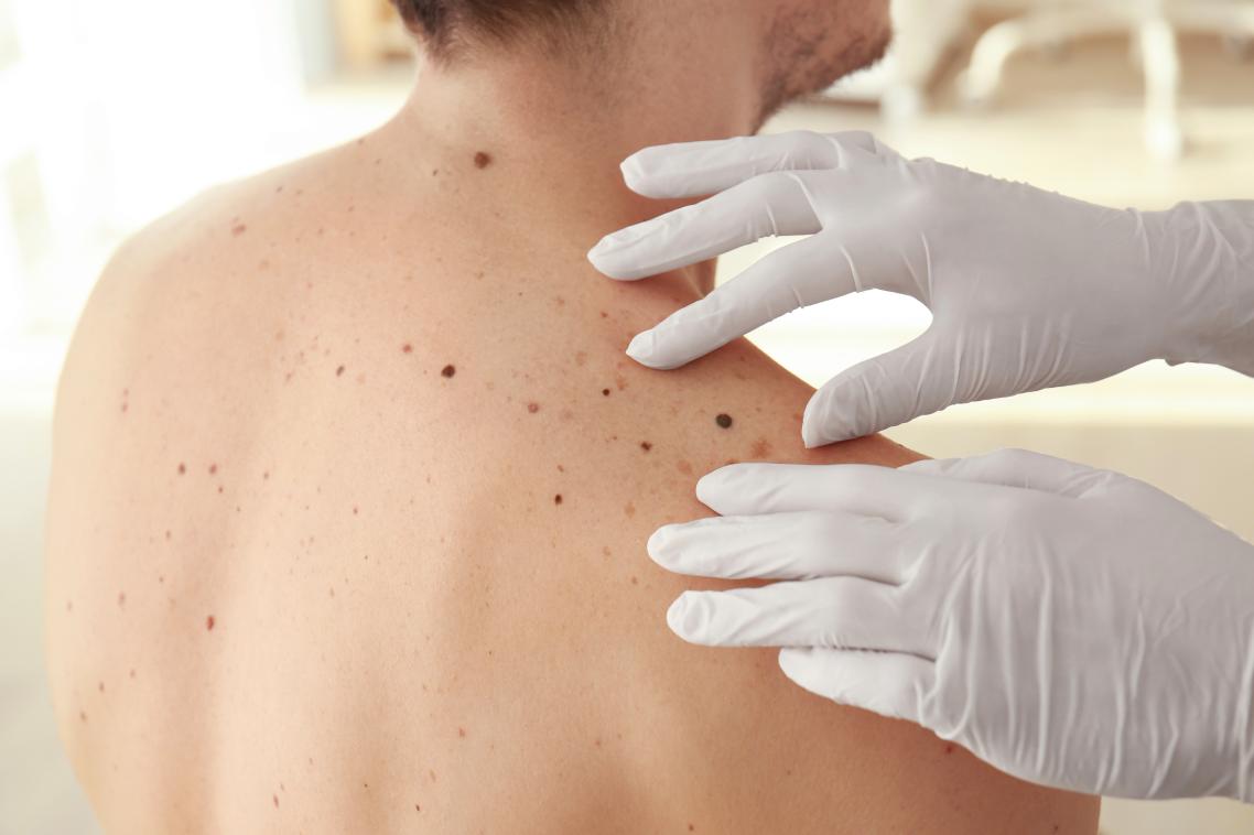 A man without a shirt getting a mole examined on his back.