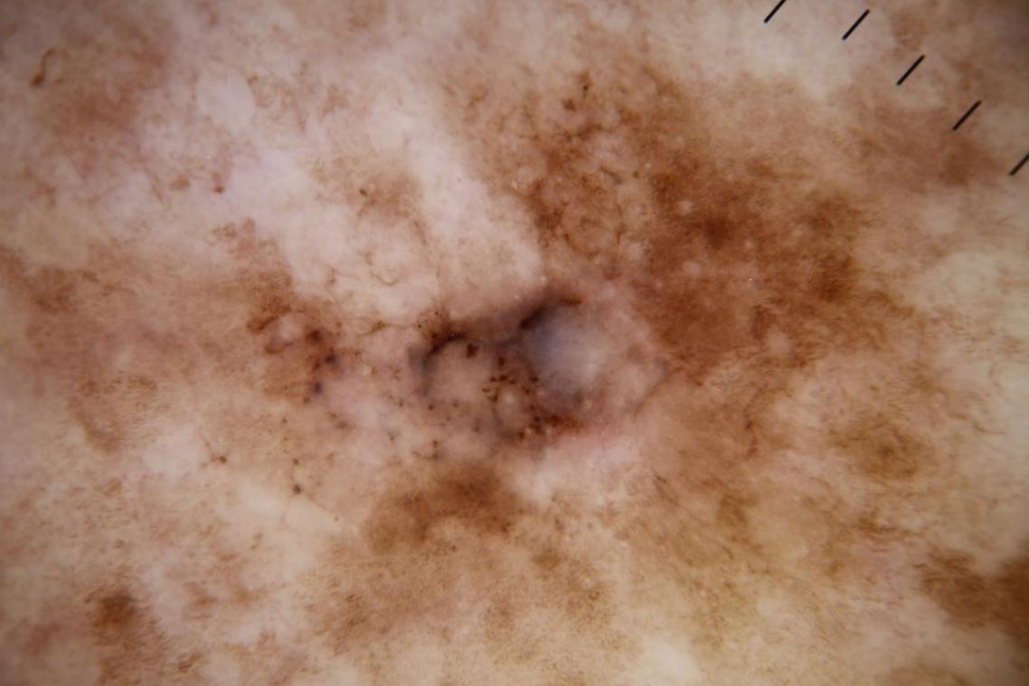 Close up of melanoma damaged skin
