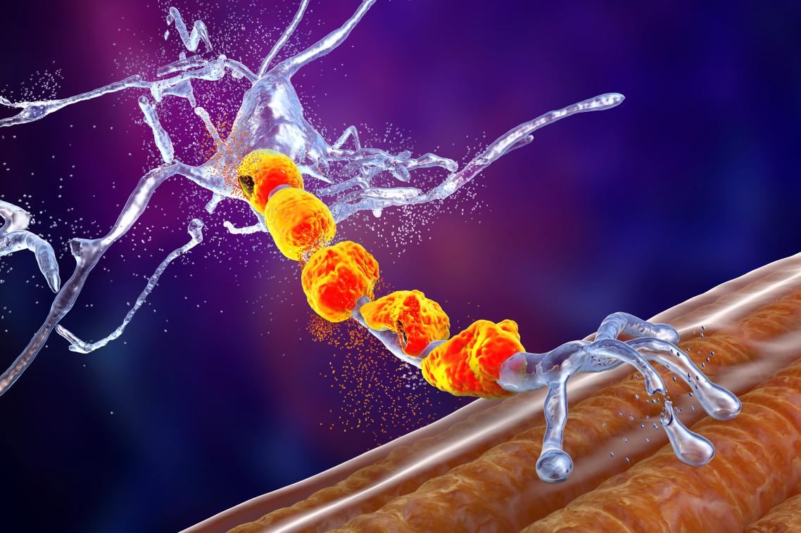 A graphic showing deteriorating motor neurons