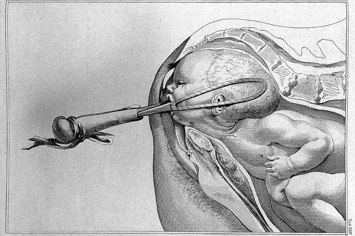 Illustration from “A sett of anatomical tables, with explanations, and an abridgment, of the practice of midwifery” by William Smellie, M.D., 1754.