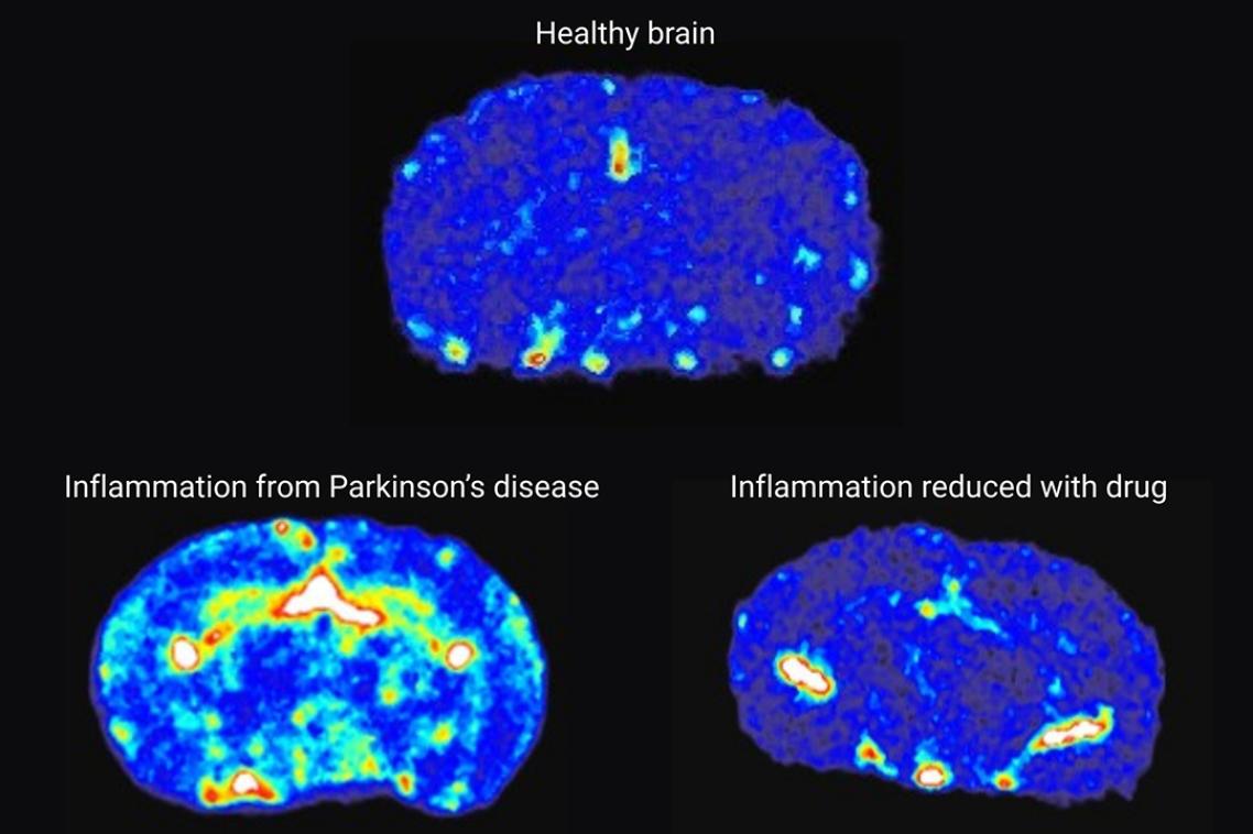 3 brain scans showing inflammation in the brain