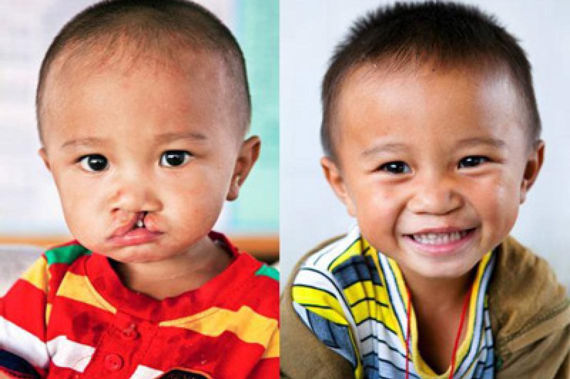 Bao, before and after cleft lip surgery at an Operation Smile medical mission.