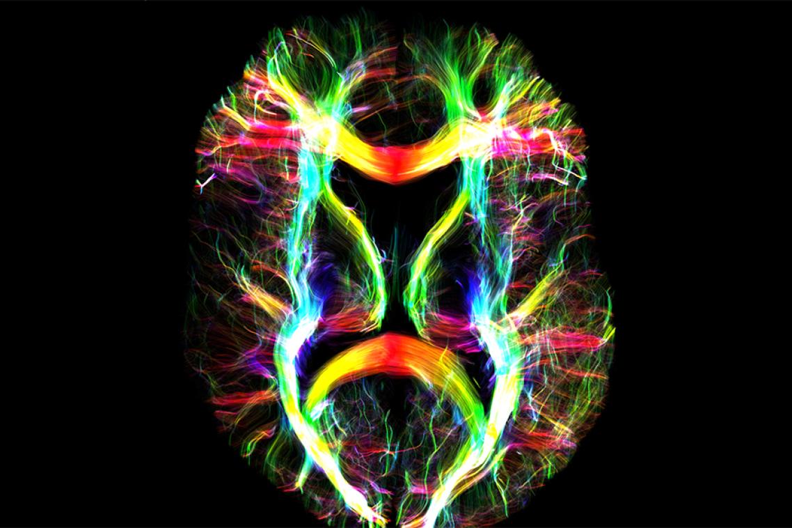 MRI image - white matter fibres in the human brain