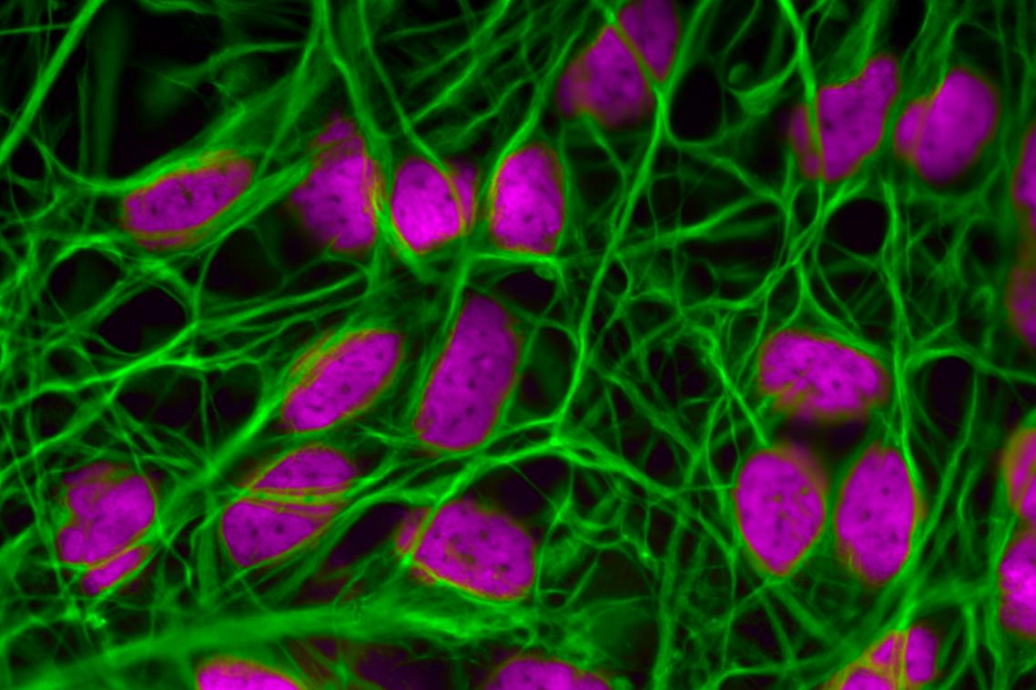 Research suggests calcium movement in cells goes awry in both breast cancers and metastatic tumours in the brain