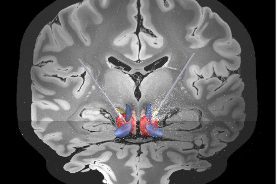 Electrodes implanted into the region of the brain involved in mediating sustained stress and anxiety