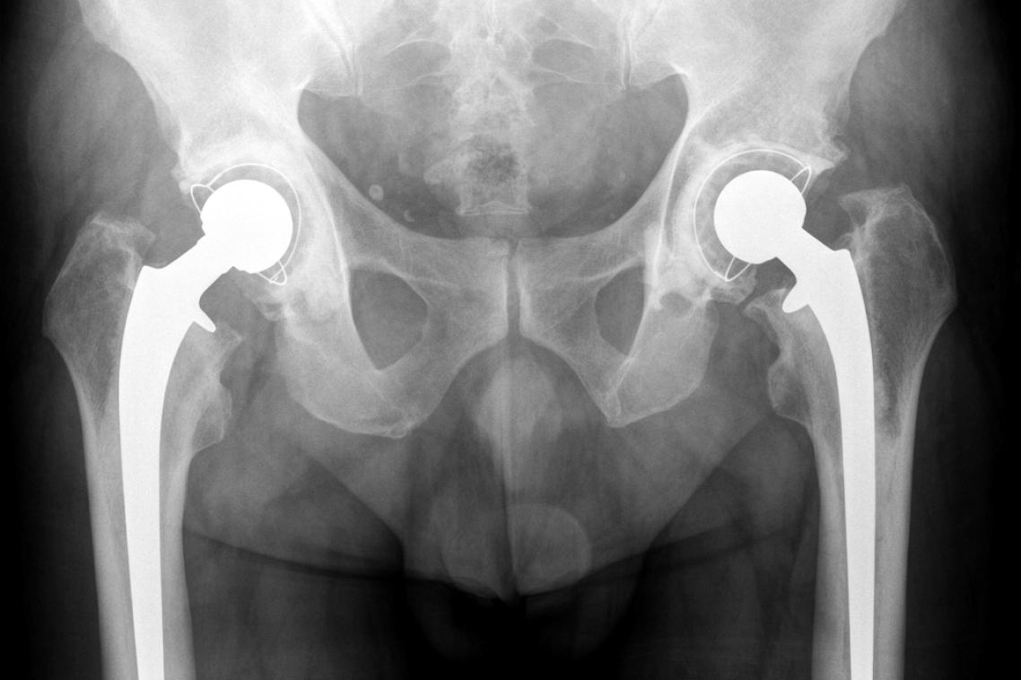 Increased fractures linked to common treatment.