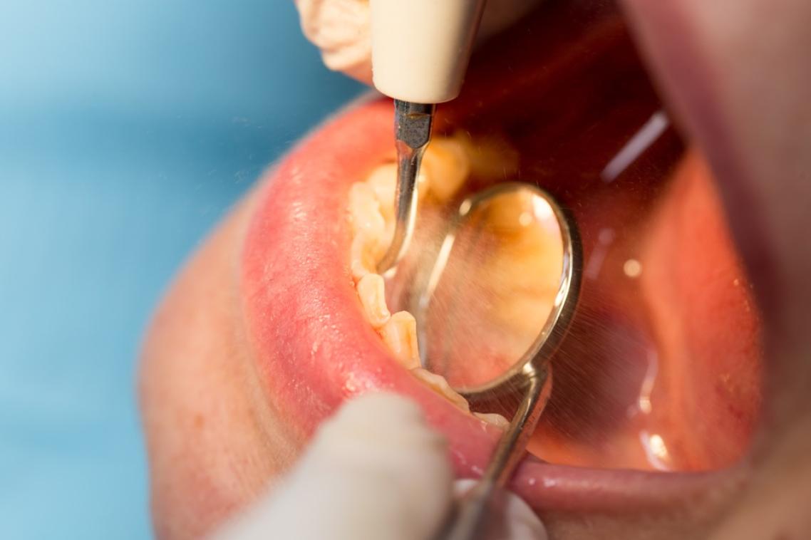 People with substance use disorders have more tooth decay and periodontal disease than the general population, but are less likely to receive dental care.
