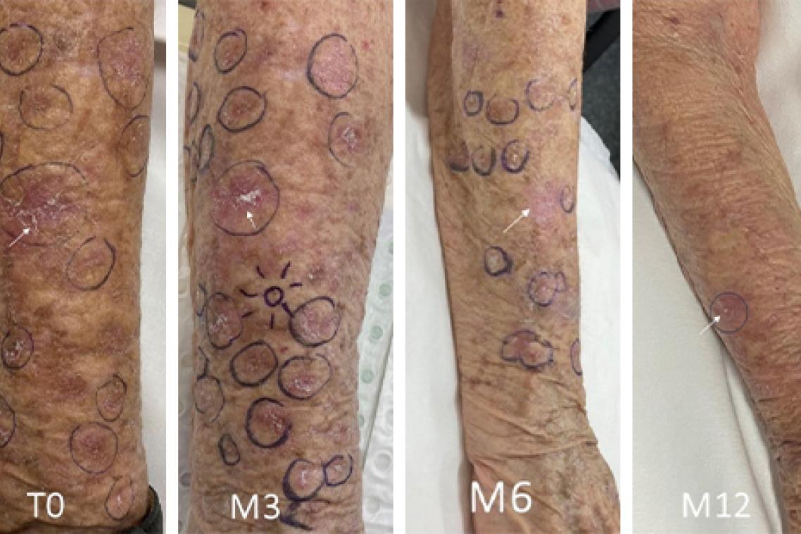 Photos of patient's forearm showing the decrease in lesions over a 12-month period.