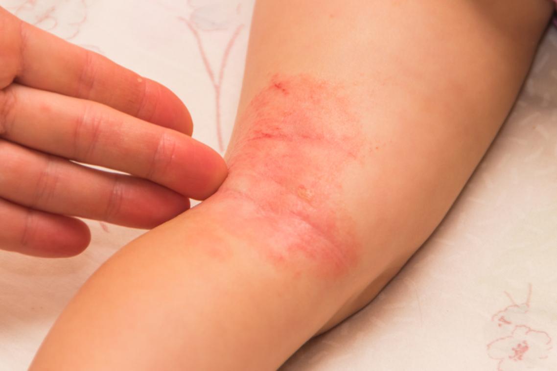 Istock image of crook of child's knee with eczema all over it