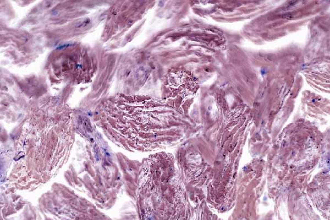 Image of pink-coloured cancer cells