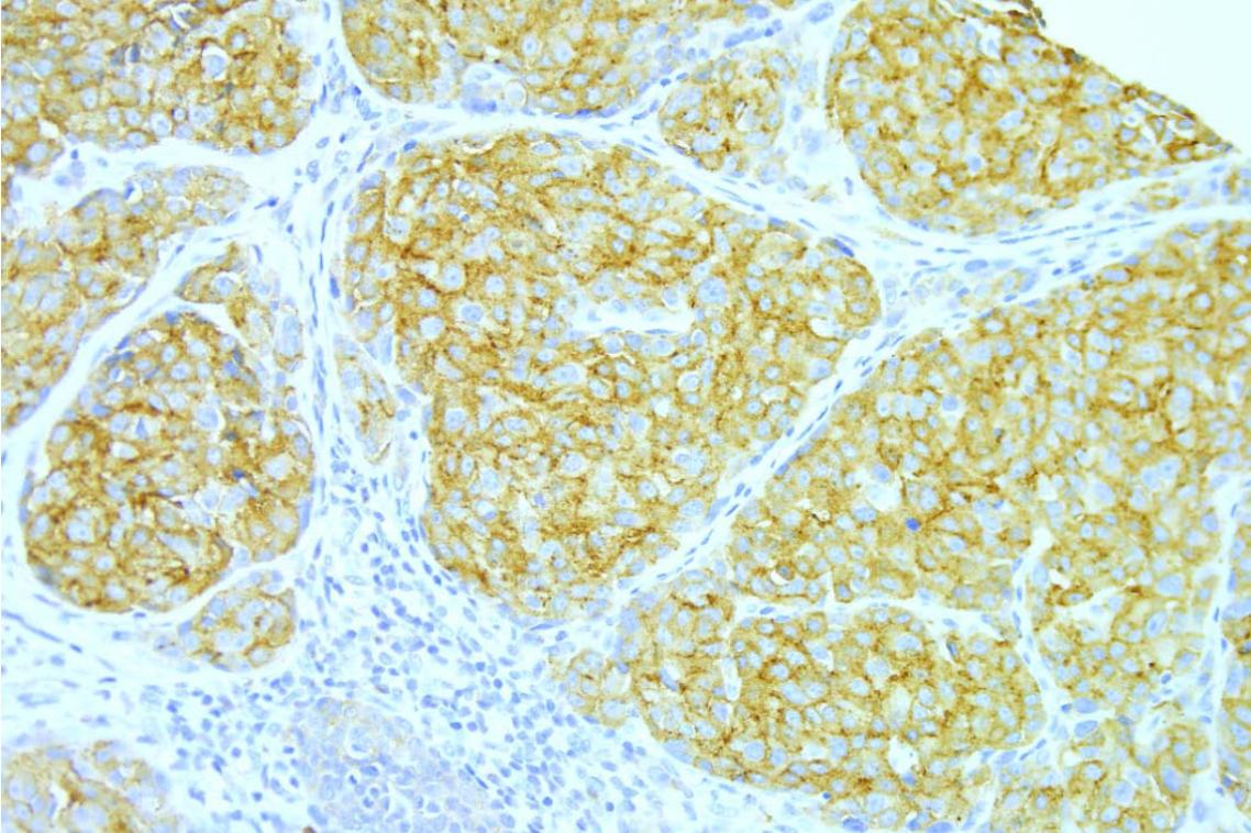 Areas containing RAB27A molecules (brown staining) within a section of a melanoma.
