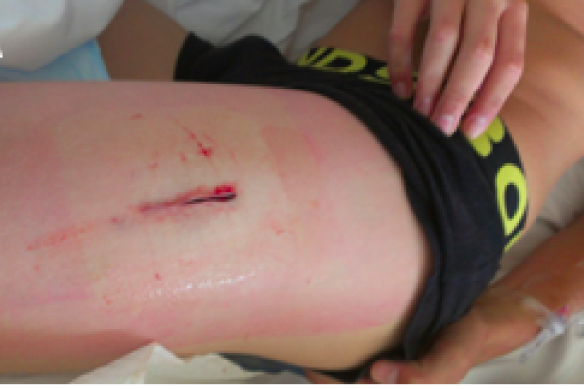 Result of open biopsy of thigh muscle