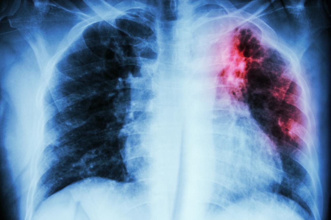 Scan-of-upper-body-showing-impact-of-tuberculosis-in-the-right-lung