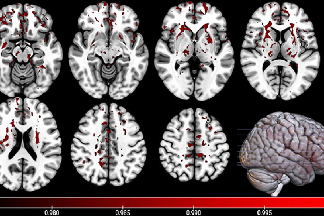 a series of black and white images of sections of a brain with red patches