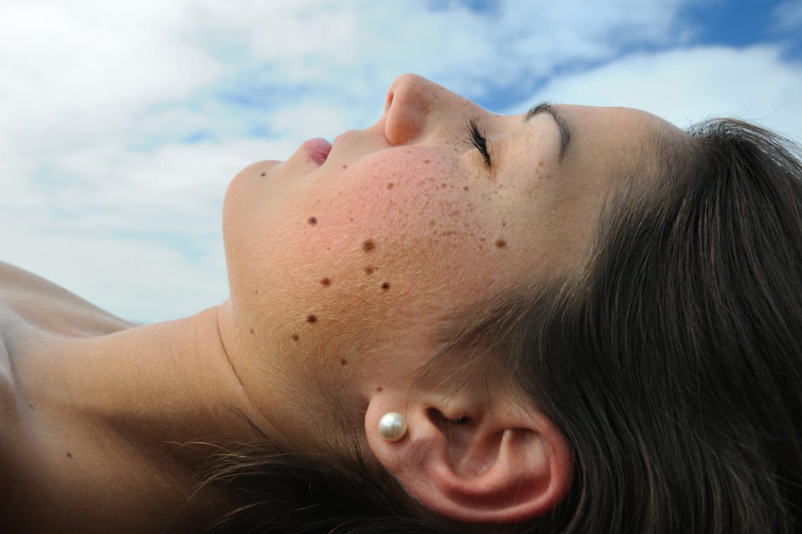 Half of all melanomas develop from a naevus