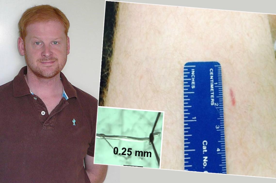 Dr Bradley Launikonis and a thigh biopsy