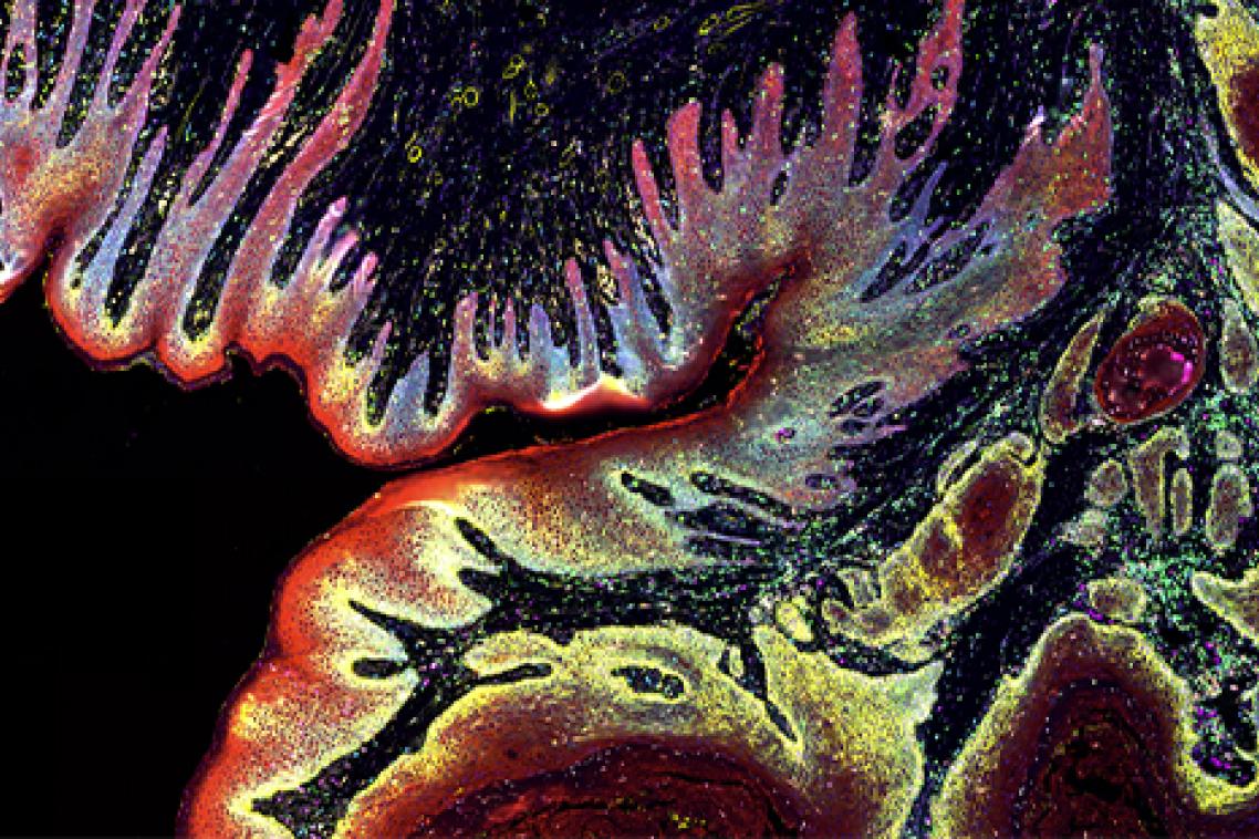 A digital image of a skin cancer located in the head and neck. The skin cells are shown in bright red, with the tumour pockets in dull red surrounded by yellow. Immune cells are patrolling the tissue in green and magenta.