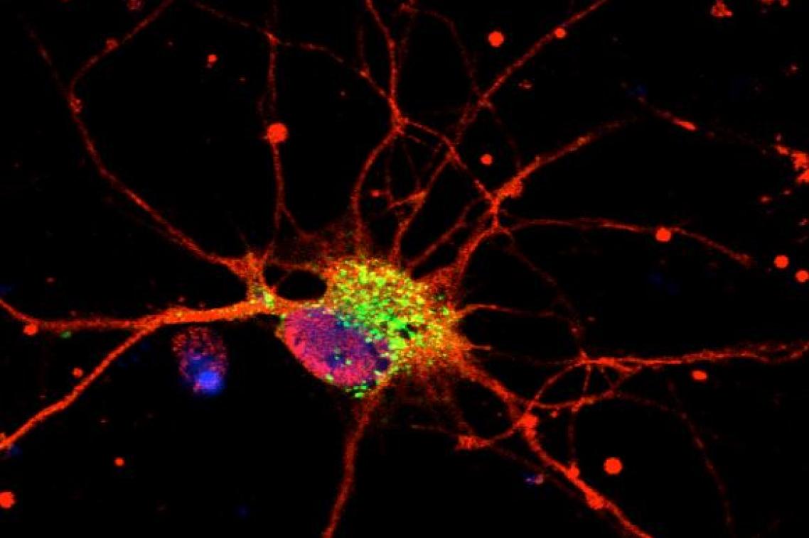 Neurodegeneration in action. The mutated Munc18-1 proteins (green in this image) trigger the clumping of α-Synuclein (large red blobs). 