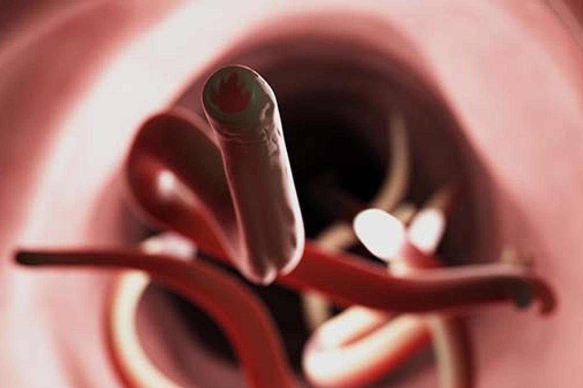 An artist's impression of hookworm inside a human intestine.