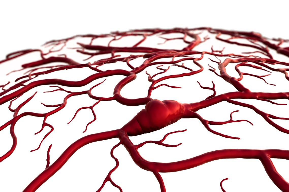 Stroke claims six million lives worldwide each year