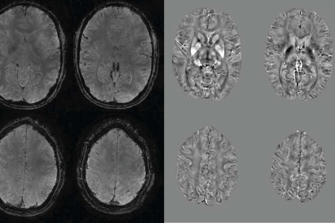 Accelerated MRI brain mapping technique to improve neurodegenerative diagnosis