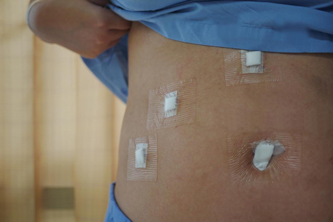 A woman lifts her shirt to show dressings from keyhole surgery on her abdomen.