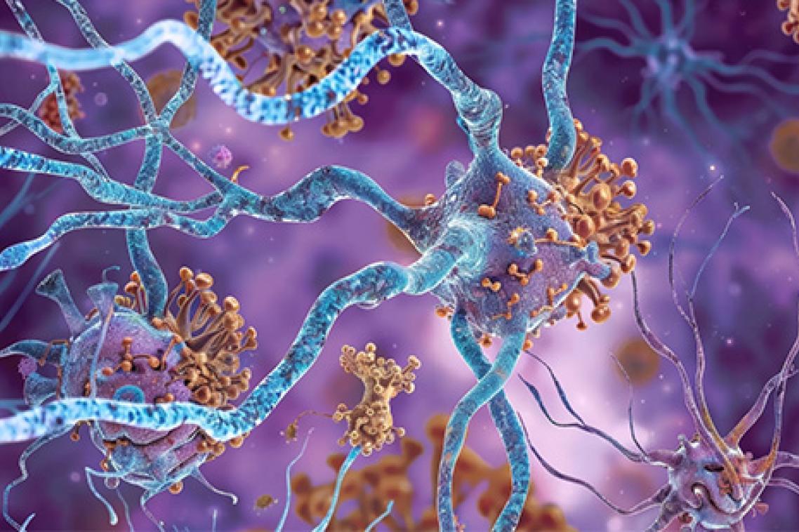 An illustration of the protein buildup on neurons that contributes to motor and cognitive symptoms.