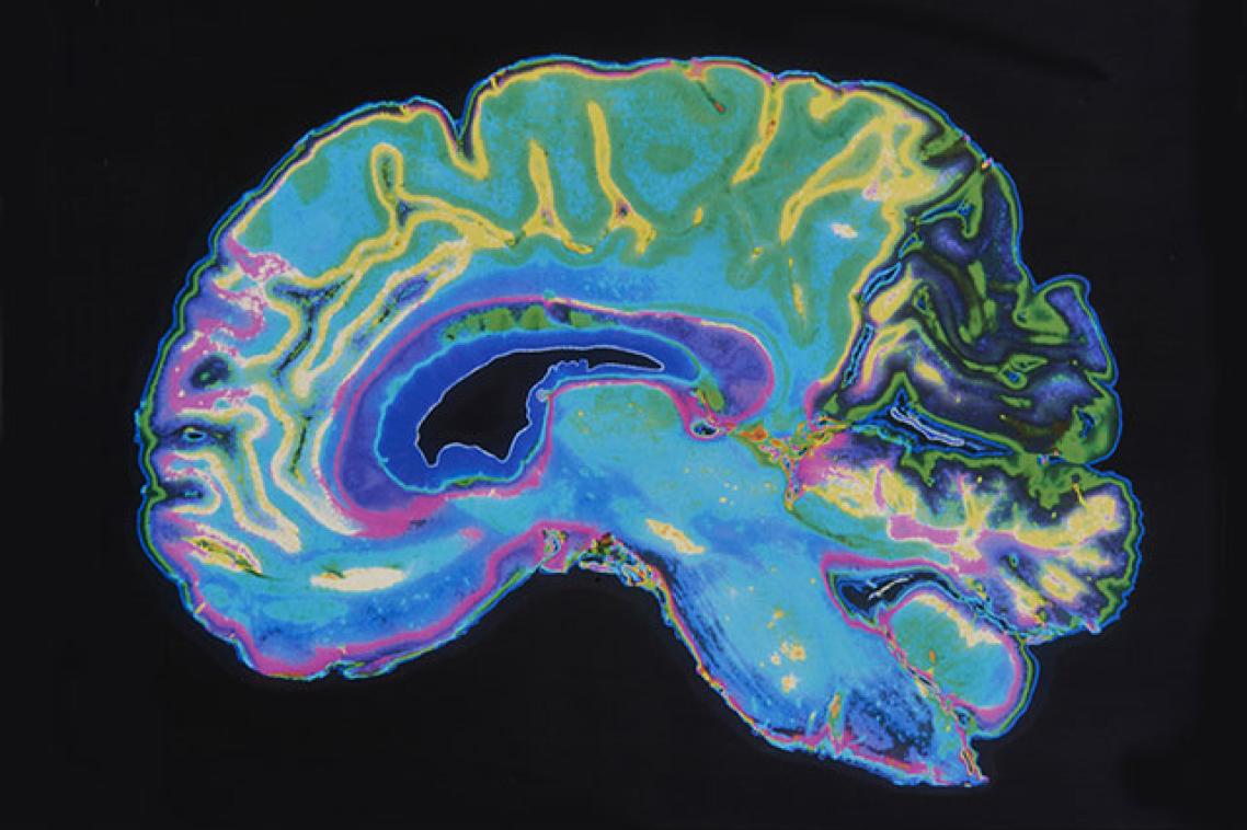 Brain scan