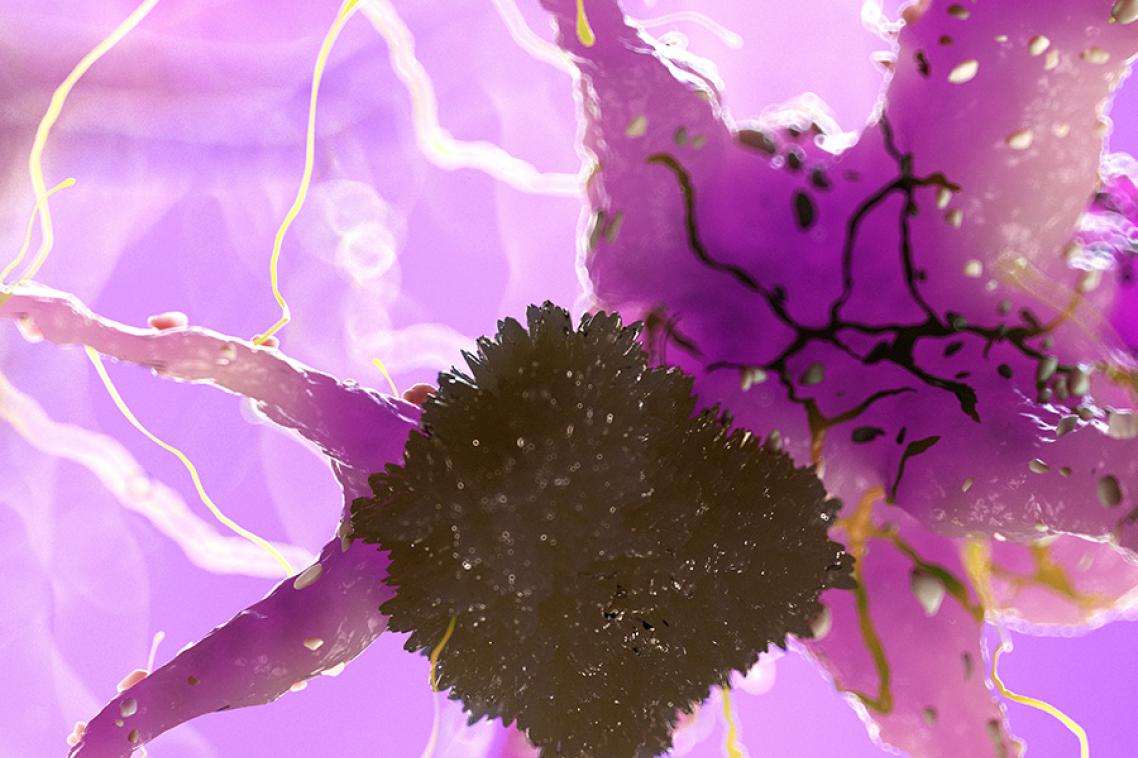 3d rendered medically accurate illustration of amyloid plaques on a nerve cell